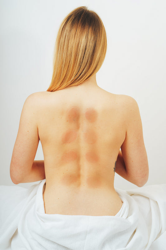 Schröpftherapie: Warum entstehen beim Schröpfen blaue Flecken